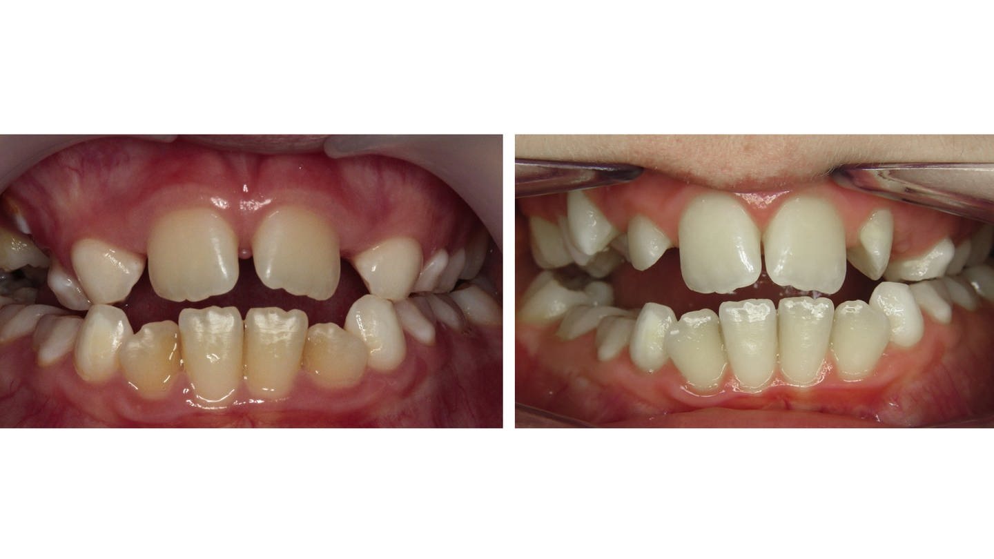 Promi Zähne vor und nach der Zahnkorrektur