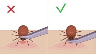 So geht's richtig: Beim Entfernen sollte eine Zecke mit einem spitzen Gegenstand am Kopf angefasst werden. Wichtig ist, dass ihr nicht auf den Körper drückt, weil die Zecke sonst vermehrt Krankheitserreger in die Einstichstelle pumpt.