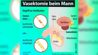 Eine Grafik einer Vasektomie.